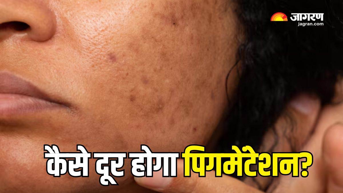 https://www.jagranimages.com/images/newimg/19032025/19_03_2025-pigmentation_remedies_23901783_91440510.jpg