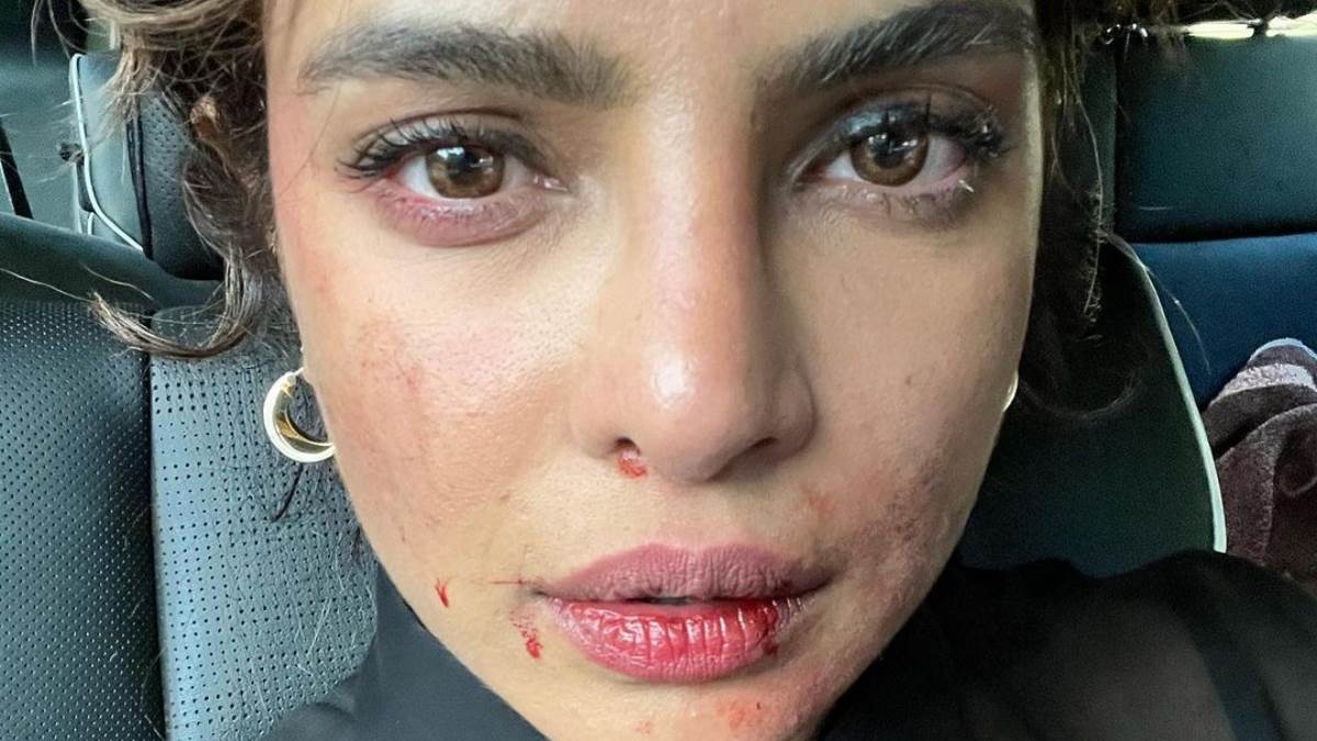 priyanka chopra was injured while performing stunts herself in the shooting of citadel
