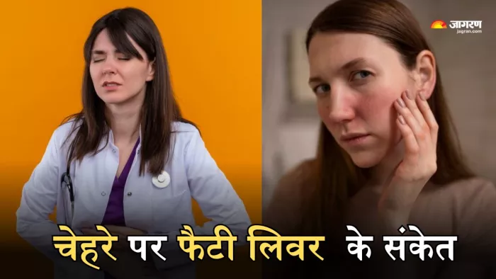 चेहरे पर दिखने वाले इन संकेतों से लगा सकते हैं फैटी लिवर का पता