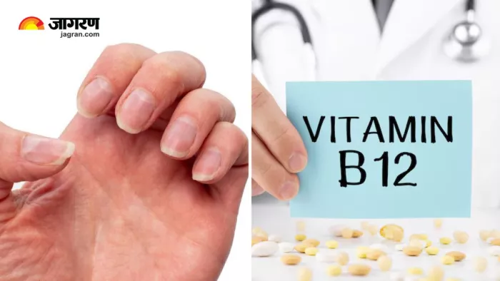 Vitamin-B12 Deficiency: क्या आपके नाखून दे रहे हैं विटामिन बी12 की कमी का संकेत? (Image Source: Freepik)