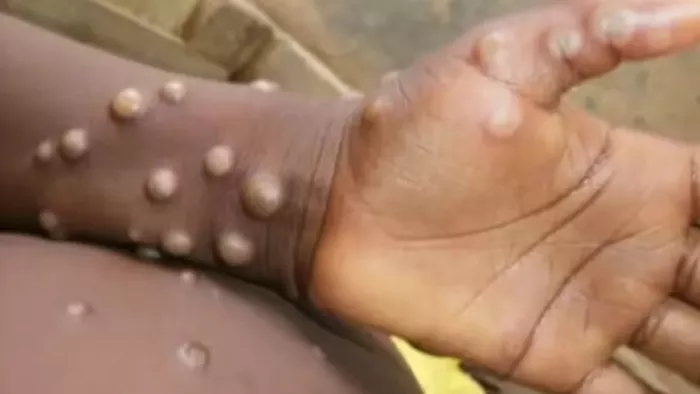 भारत में बढ़ रहा एमपॉक्स को लेकर खतरा (फाइल फोटो)