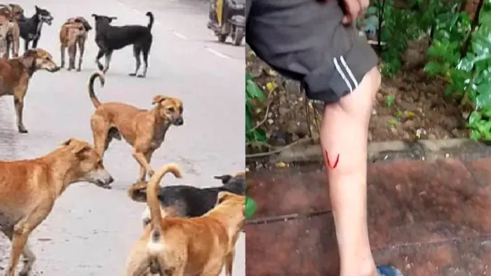 कुत्ते के काटने के बाद पांव पर घाव दिखाते हुए रोहिणी सेक्टर-3 निवासी सुनील सिंगल। सौ. स्वयं