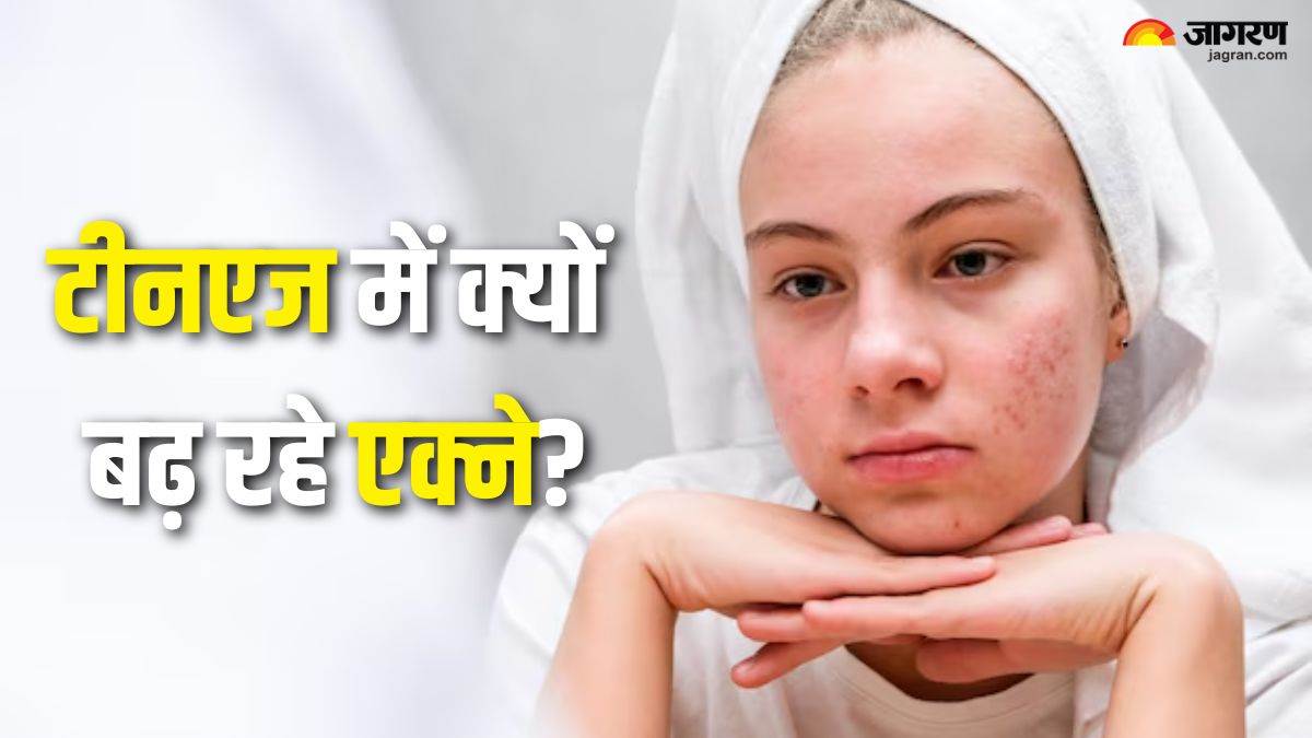 https://www.jagranimages.com/images/newimg/19092025/19_09_2025-acne_in_teenage_24052464.jpg
