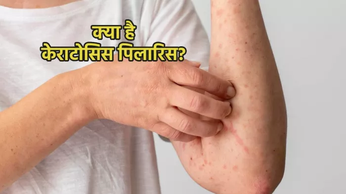 क्या है केराटोसिस पिलारिस की समस्या, इसके कारण व लक्षण