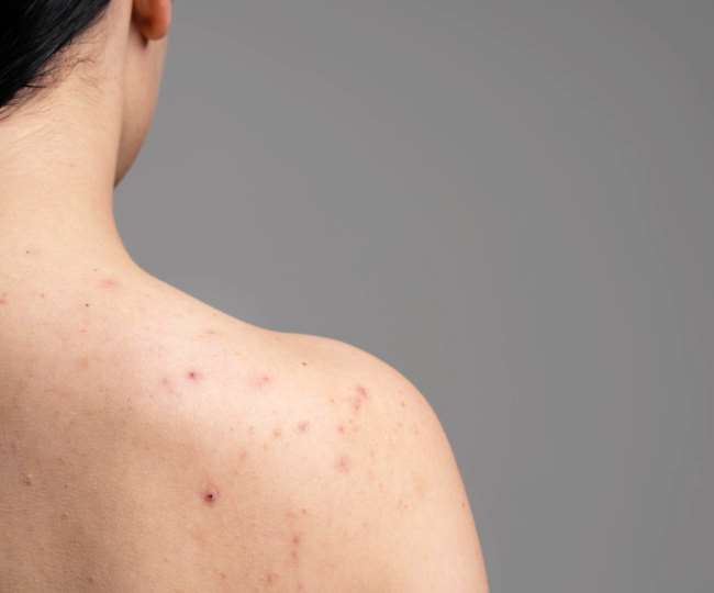 https://www.jagranimages.com/images/newimg/20042022/20_04_2022-back_pimples_f_22643390.jpg