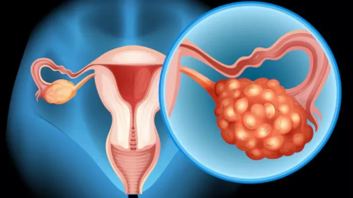 क्या है Ovarian Cyst का कारण? (Image Credit- Freepik)