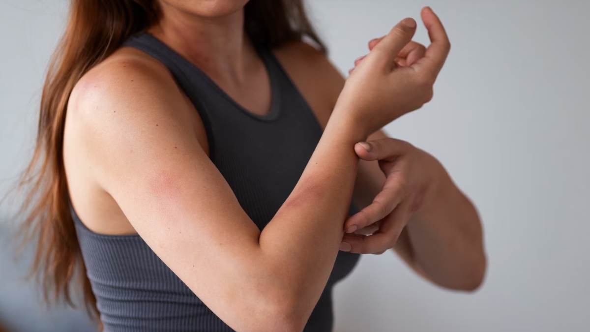 https://www.jagranimages.com/images/newimg/20082023/20_08_2023-remedies_for_mosquito_bites_f_23506526.jpg