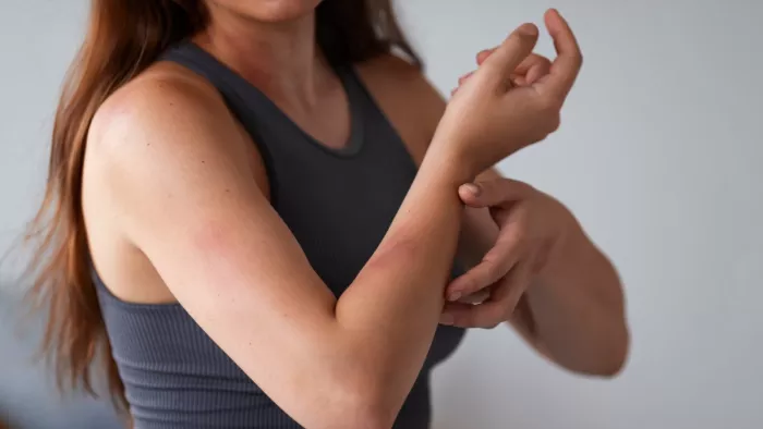 World Mosquito Day 2023: मॉस्किटो बाइट से बचने के 4 घरेलू उपाय