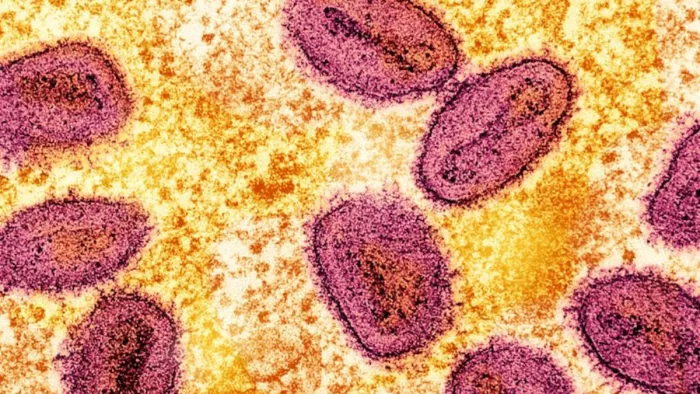 mpox: पाकिस्तान में नहीं मिला एमपॉक्स का नया स्ट्रेन।