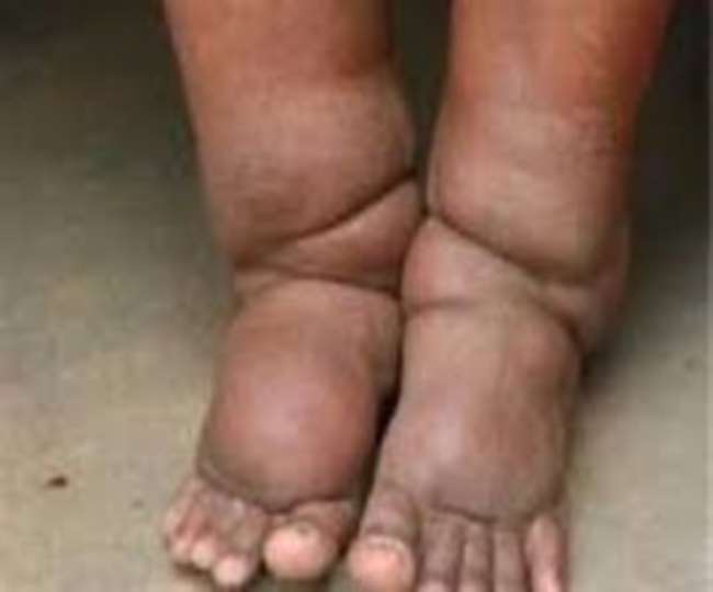 must eat once a year medicine to prevent filariasis know the symptoms of this deadly disease