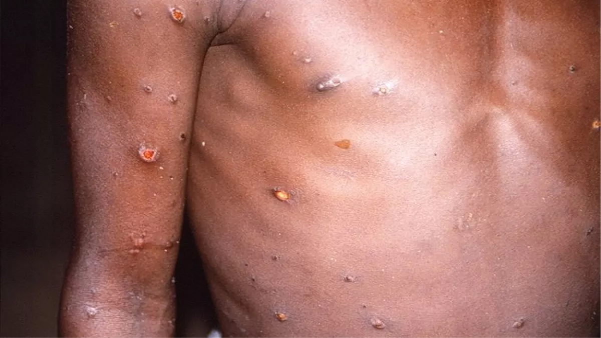 Monkeypox Outbreak: 11 देशों में मिले 80 मामले, भारत में भी मंडराया खतरा; WHO का रिसर्च जारी