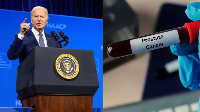 Joe Biden Prostate Cancer: पुरुषों में होने वाला सबसे कॉमन कैंसर है प्रोस्टेट कैंसर (Picture Courtesy: Freepik)