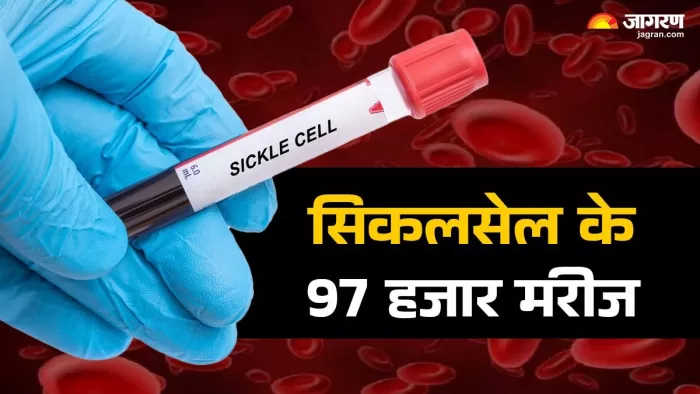 ओडिशा में दो साल में 97 हजार सिकलसेल के मरीज मिले