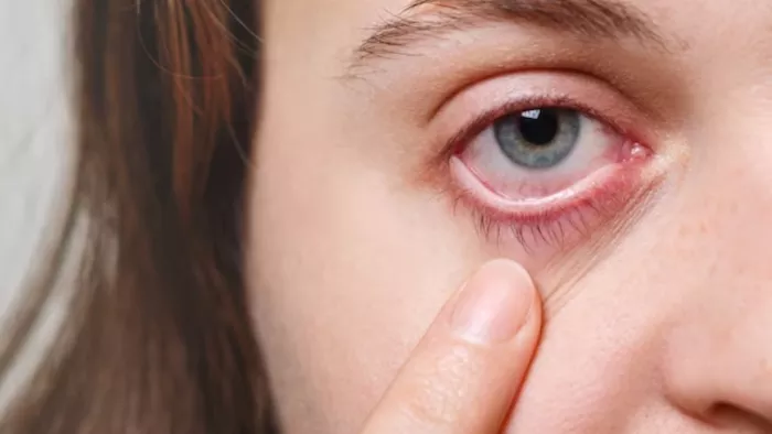 Dry Eyes: आंखों को स्वस्थ रखने के लिए खाएं ये फूड्स