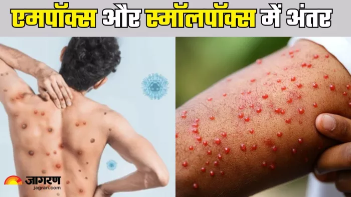 एमपॉक्स और स्मॉलपॉक्स में अंतर (Picture Credit- Freepik)