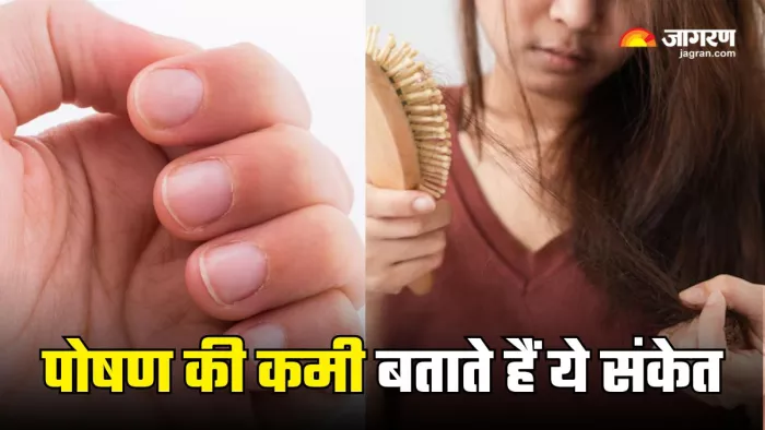 चीख-चीख कर पोषण की कमी बयां करते हैं ये संकेत (Picture Courtesy: Freepik)