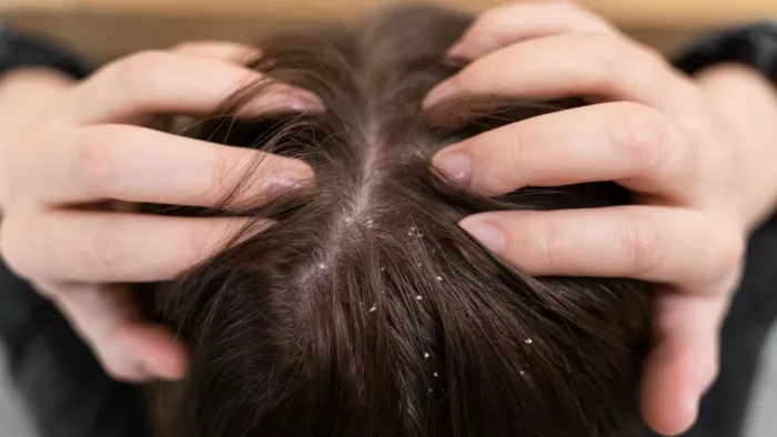 Hair Care: नींबू के रस से डैंड्रफ की समस्या दूर होती है।