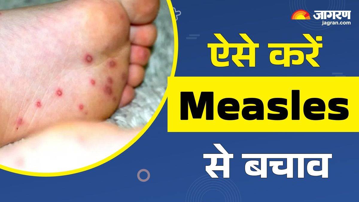 https://www.jagranimages.com/images/newimg/22032025/22_03_2025-measles_23903969.jpg