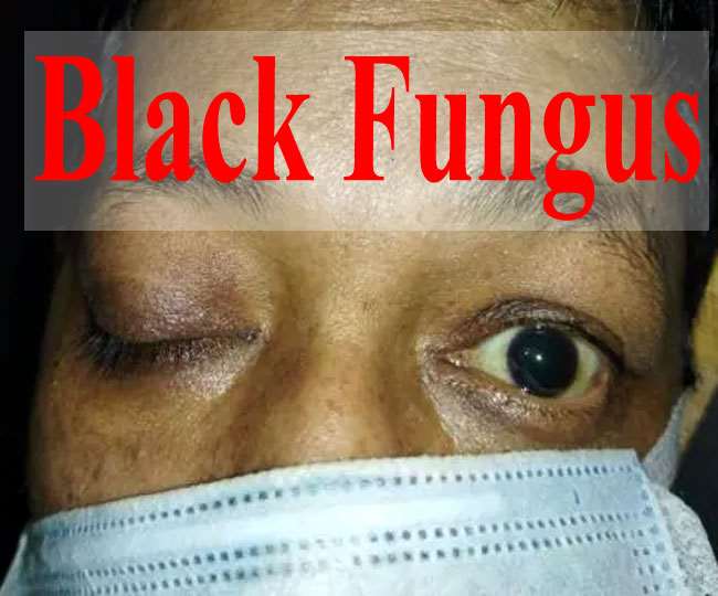Black Fungus Patients Treatment With Black Fever Medicines In Jharkhand Know Black Fungal Infection Symptoms Black Fungus Patients Treatment With Black Fever Medicines In Jharkhand Know Black Fungal Infection Symptoms