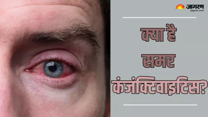 एक्सपर्ट से जानें क्या है Summer Conjunctivitis (Picture Credit- Freepik)
