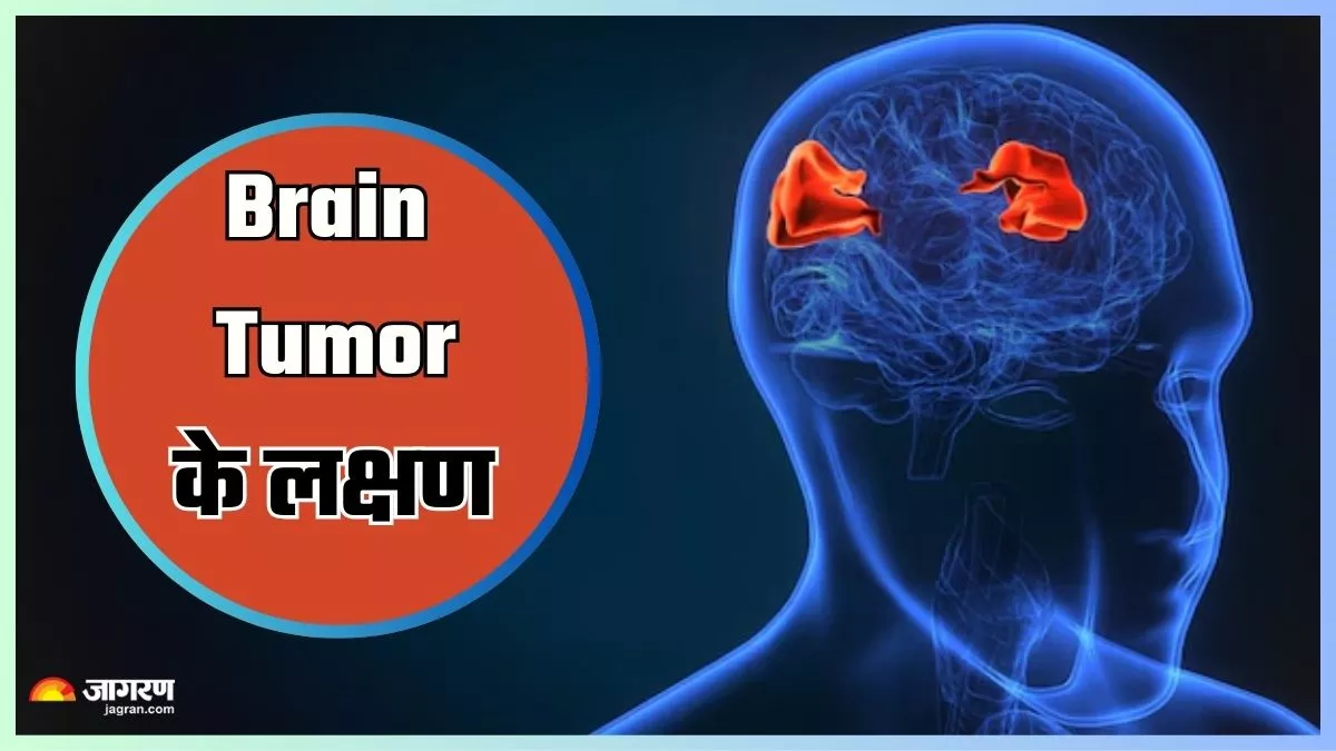 आपको भी लगातार होता है स‍िरदर्द? Brain Tumor का हो सकता है संकेत; 10 लक्षणों से करें बीमारी की पहचान