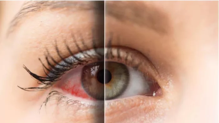 Conjunctivitis: तेजी से फैल रहा आंखों का संक्रमण, सावधानी और सतर्कता जरूरी;
