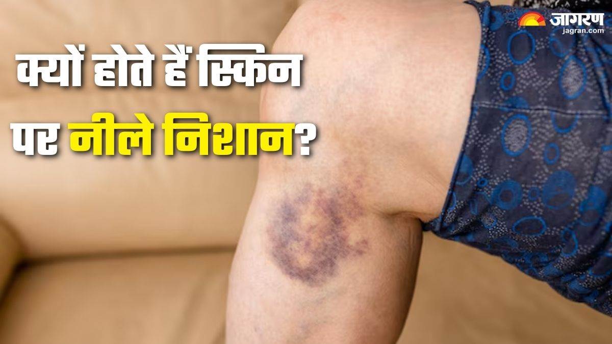 https://www.jagranimages.com/images/newimg/22082025/22_08_2025-bruising_on_skin_24021405.jpg