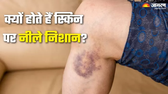 स्किन पर नीले निशान क्यों पड़ते हैं? जानिए पोषक तत्वों की कमी और समाधान (Picture Credit- Freepik)