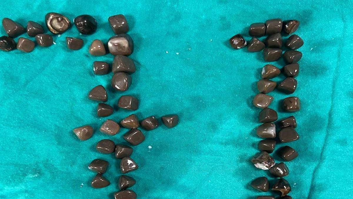 https://www.jagranimages.com/images/newimg/22082025/22_08_2025-kidney_stones_24021414.jpg