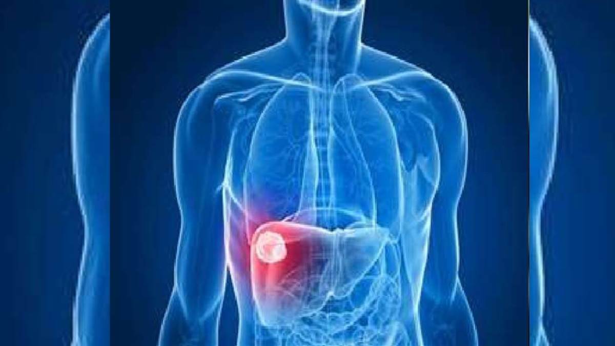  72 वर्षीय व्यक्ति के लिवर से 2.1 किलोग्राम का ट्यूमर निकाला गया