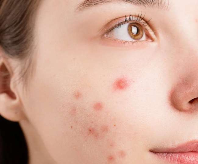 इन घरेलू और नेचुरल उपायों से भरें पिंपल्स की वजह से चेहरे पर हुए गड्ढे