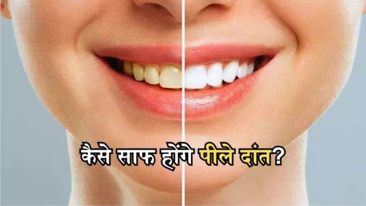 https://www.jagranimages.com/images/newimg/22112024/22_11_2024-yellow_teeth_23835403.jpg