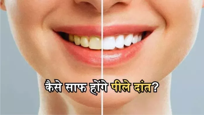 दांतों के पीलेपन की समस्या से छुटकारा दिलाएंगे ये घरेलू उपाय।