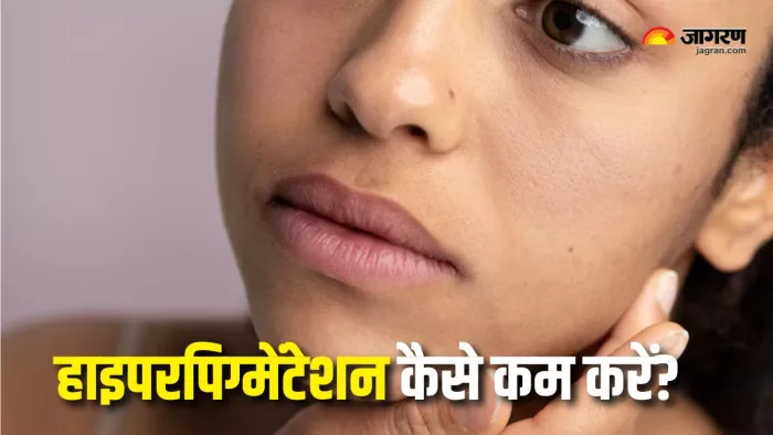 Hyperpigmentation in Summer: गर्मियों में ऐसे करें हाइपरपिग्मेंटेशन से बचाव (Picture Courtesy: Freepik)