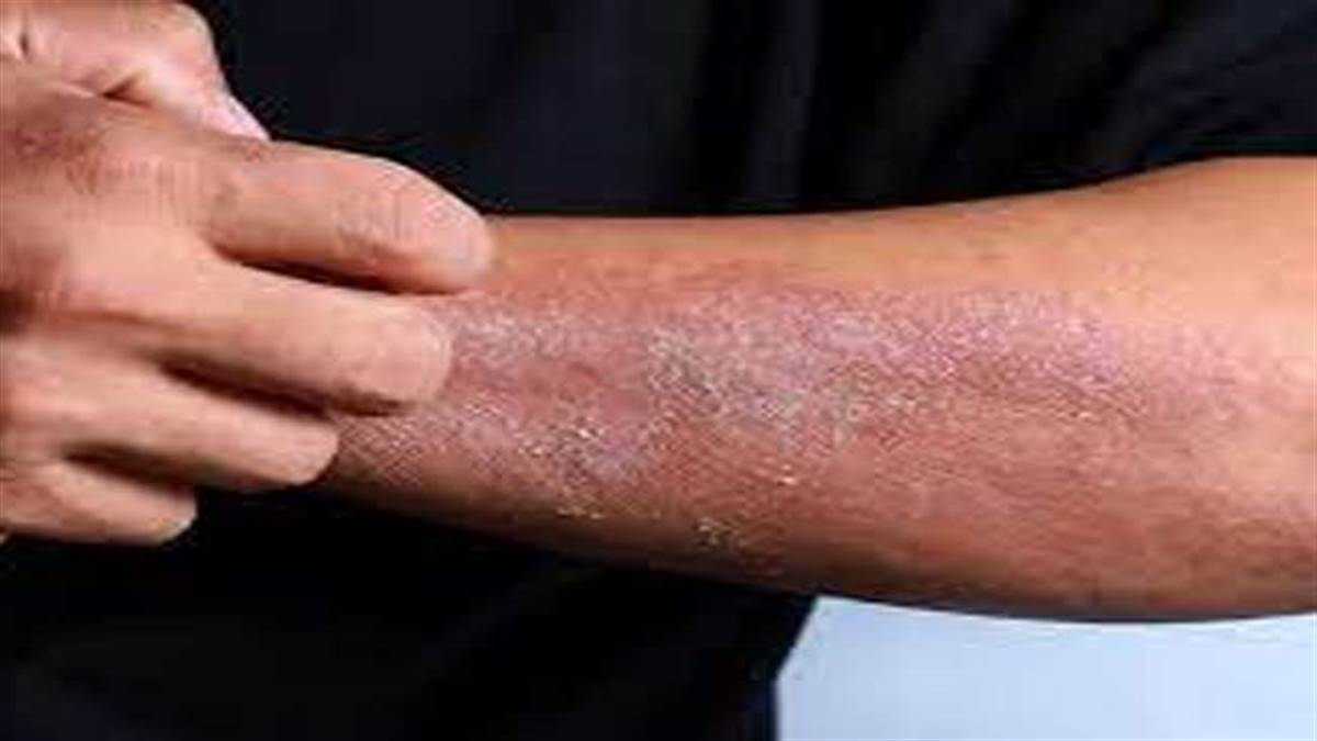 गर्मी में उल्टी-दस्त के अलावा त्वचा संबंधी बीमारी का बढ़ प्रकोप