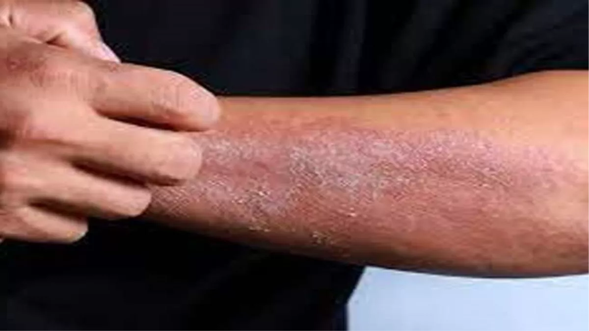 गर्मी में उल्टी-दस्त के अलावा त्वचा संबंधी बीमारी का बढ़ प्रकोप, ऐसे बरतें सावधानी