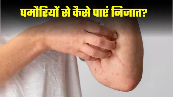 घमौरियों से निजात दिलाएंगे ये घरेलू नुस्खे। (Image Credit- Freepik)