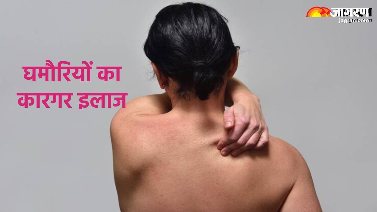 https://www.jagranimages.com/images/newimg/23062024/23_06_2024-home_remedies_for_prickly_heat_23744531.jpg