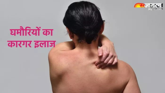 घमौरियां दूर करने के घरेलू उपाय (Pic credit- freepik)