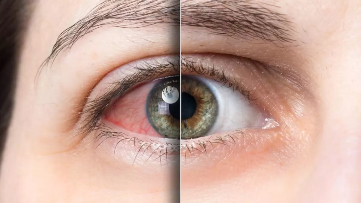 https://www.jagranimages.com/images/newimg/23072023/23_07_2023-eye_flu_23479557.jpg