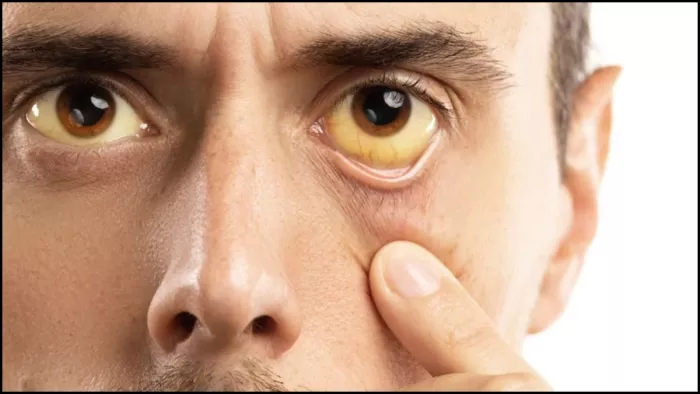 Jaundice: कभी सोचा है,पीलिया में क्यों आंखों और त्वचा का रंग पीला पड़ जाता है