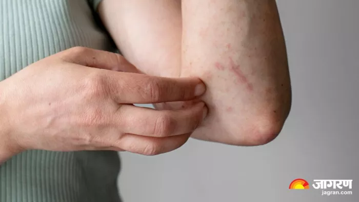 Skin Allergy के पीछे हो सकते हैं ये कारण (Image Source: Freepik)