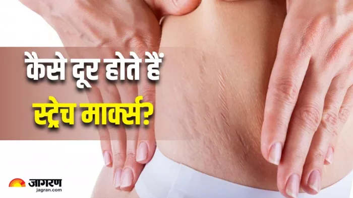 क्या स्ट्रेच मार्क्स पर Coconut Oil लगाने से कोई असर होता है? (Image Source: Freepik)