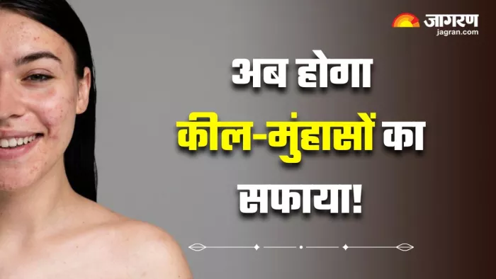 Skin Care Tips: घर की रसोई में छिपे हैं मुंहासों के रामबाण इलाज (Image Source: Freepik)