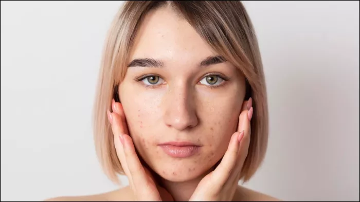 चेहरे की झाइयां दूर करने के लिए अपनाएं ये घरेलू टिप्स