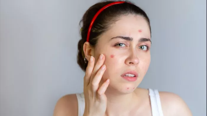 Pimple Home remedies: पिंपल के दाग-धब्बों से ऐसे पाएं राहत