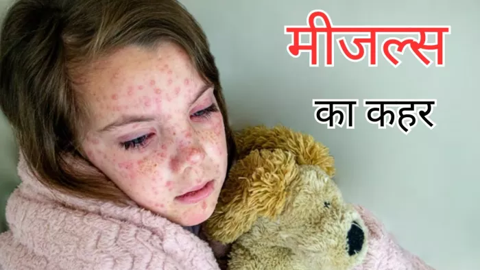 पूरी दुनिया में कहर बरपाएगा मीजल्स, WHO ने दी चेतावनी