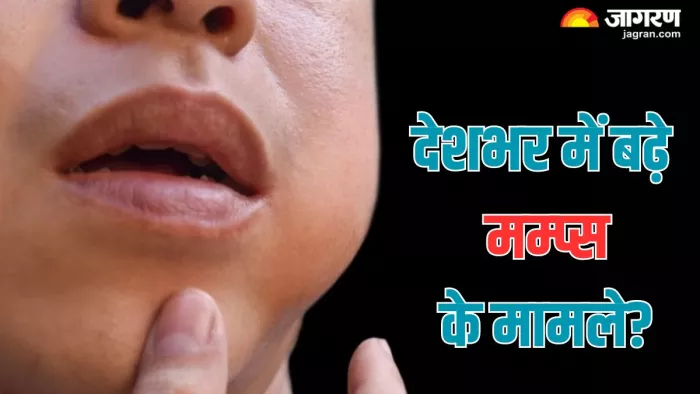 देशभर में तेजी से बढ़ रहे मम्प्स के मामले