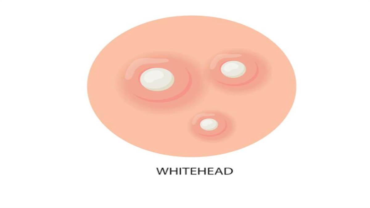Whiteheads Home remedies: व्हाइटहेड्स दूर करने के लिए अपनाएं ये घरेलू उपाय