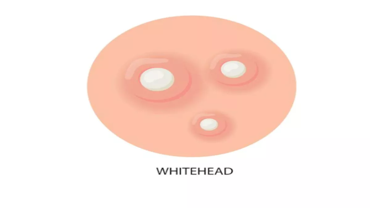 Whiteheads Home remedies: व्हाइट हेड्स ने छीन ली है चेहरे की खूबसूरती, तो इन घरेलू नुस्खों से करें इसे ठीक